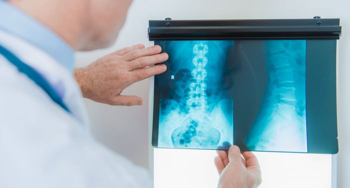 cirurgia da coluna